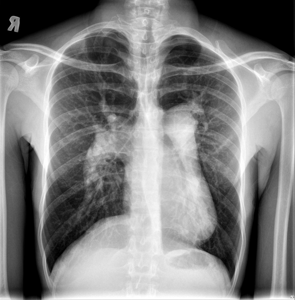 GAMBARAN HIPERTENSI PULMONAL – radiologi.id