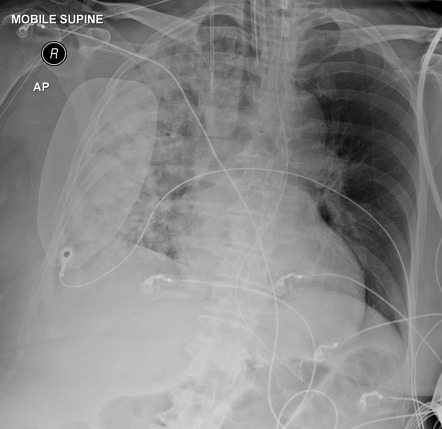 Unilateral airspace opacification | Radiology Case | Radiopaedia.org