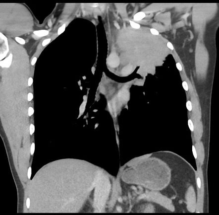 Pulmonary Hodgkin lymphoma | Image | Radiopaedia.org