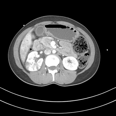 CT hypoperfusion complex from pyelonephritis | Radiology Case ...