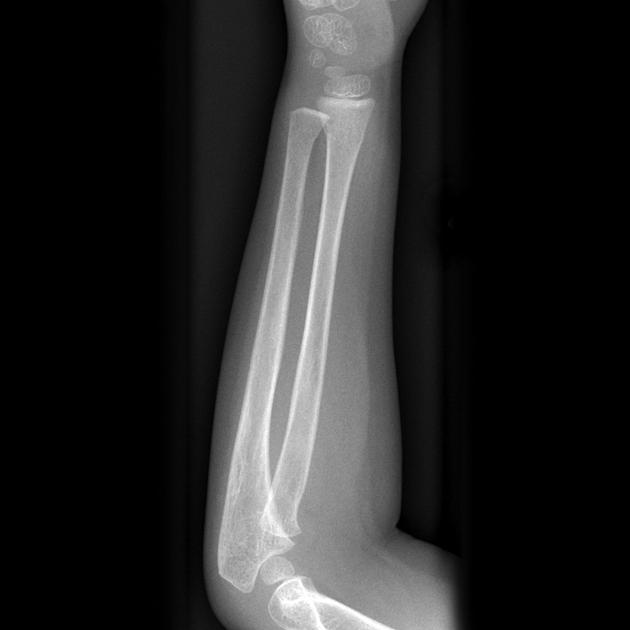 Describing a fracture an approach Radiology Reference Article