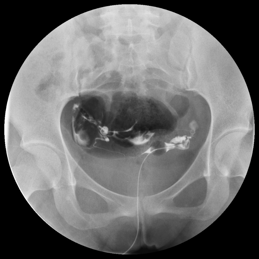 Normal Hysterosalpingogram Image