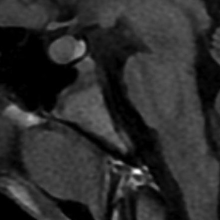 Normal bone marrow signal of the clivus | Radiology Reference Article ...