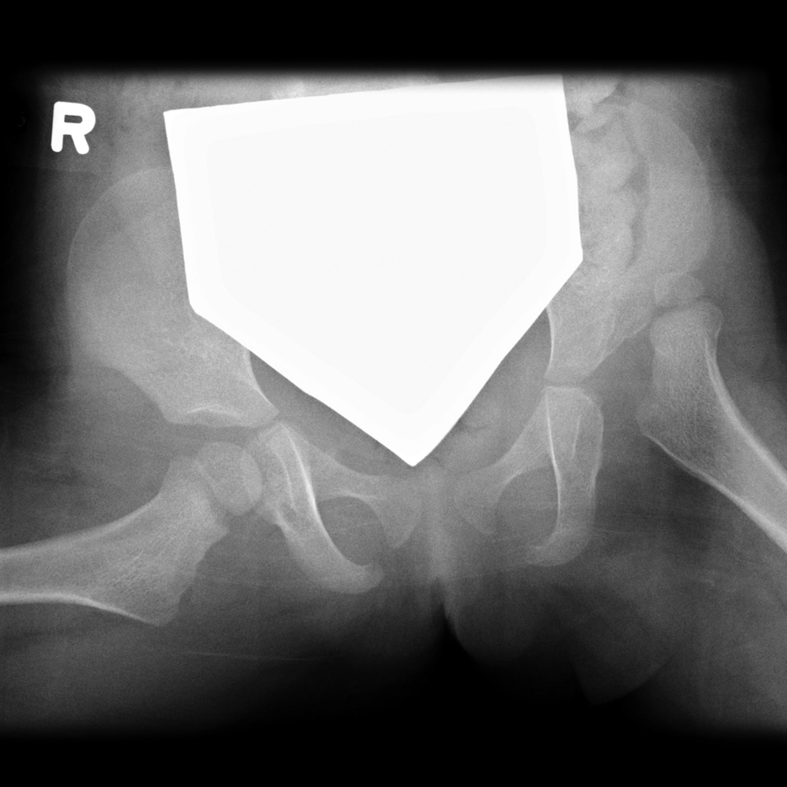 Developmental Dysplasia Of The Hip Image 4265