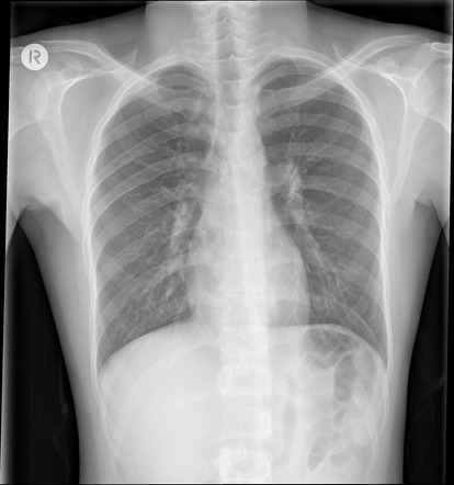 Winking owl sign (spine) | Radiology Reference Article | Radiopaedia.org