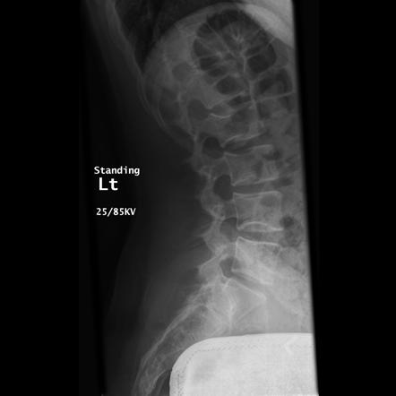 Sickle cell disease (skeletal manifestations) | Radiology Reference ...