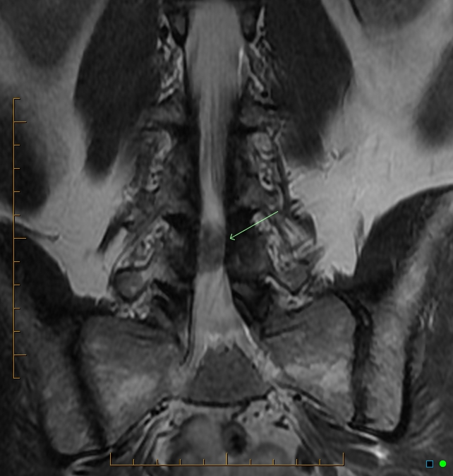 Extruded lumbar disc encircling the thecal sac | Image | Radiopaedia.org