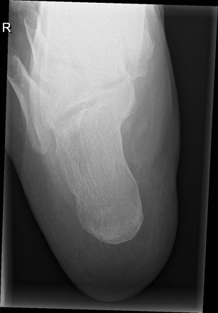 Fractured plantar calcaneal spur | Image | Radiopaedia.org