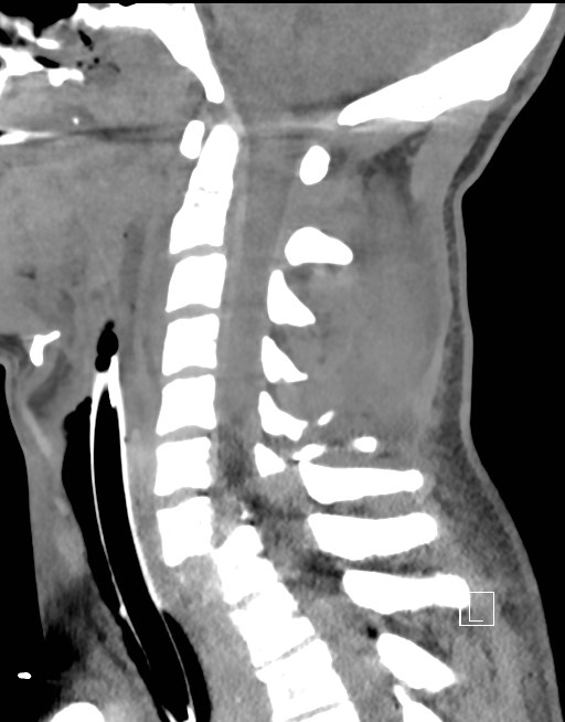 Facet joint dislocation, Jefferson and hangman fractures | Image ...