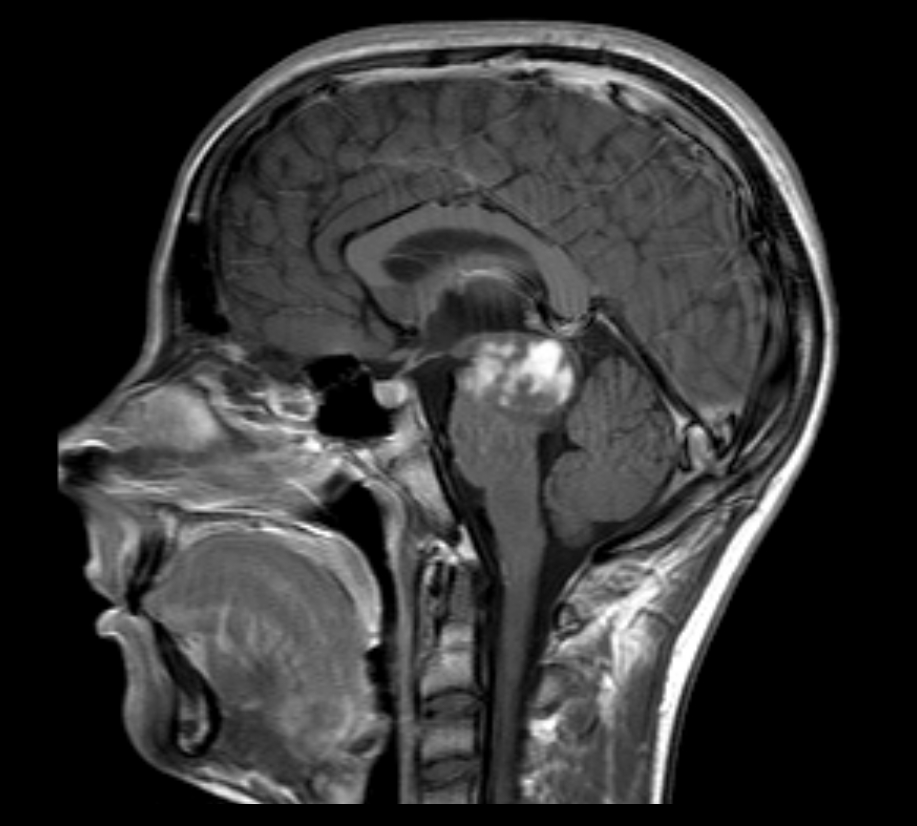 Brainstem glioma - focal midbrain | Image | Radiopaedia.org