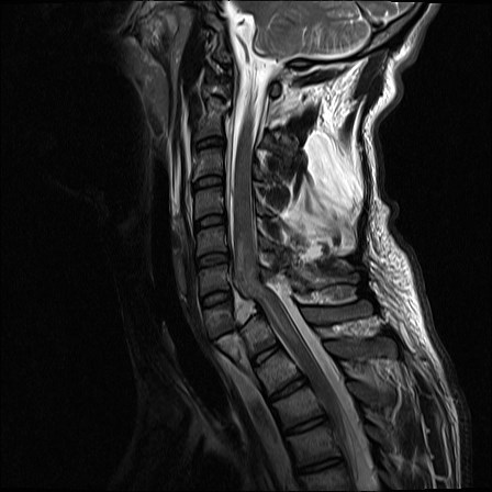 Facet joint dislocation, Jefferson and hangman fractures | Image ...