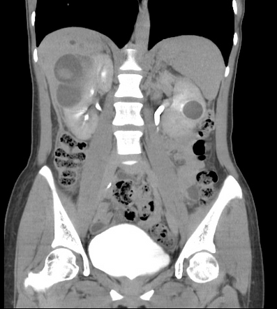 Adult polycystic kidney disease | Radiology Case | Radiopaedia.org