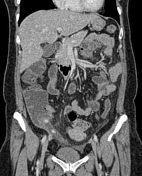 Featured image of post Appendicular Lump Radiopaedia A free online collaborative radiology this year in addition to asking you to consider becoming a radiopaedia supporter we will be sharing