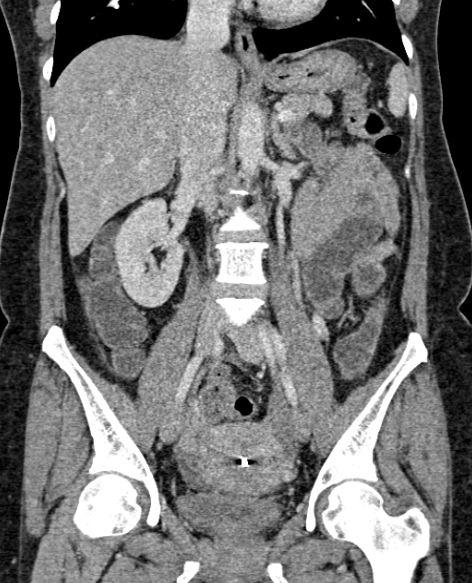 Radiopaedia Appendicitis