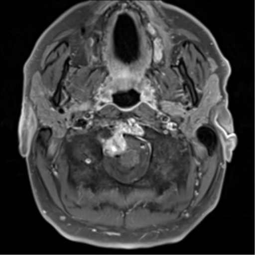 Clival chordoma invading the hypoglossal canal | Image | Radiopaedia.org