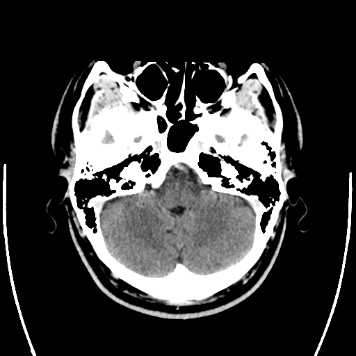 File:Oligodendroglioma (IDH-mt, 1p19q codeleted) (Radiopaedia 48852 ...