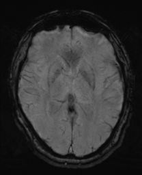 File:Oligodendroglioma (IDH-mt, 1p19q codeleted) (Radiopaedia 48852 ...