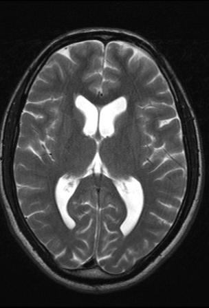 Epidermoid cyst - involving pre-pontine and basal cisterns and left CP ...