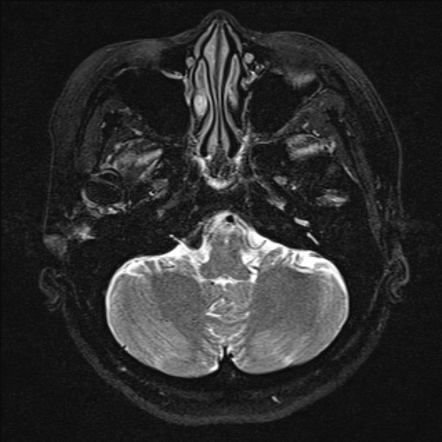 Acoustic schwannoma - intracanalicular | Image | Radiopaedia.org