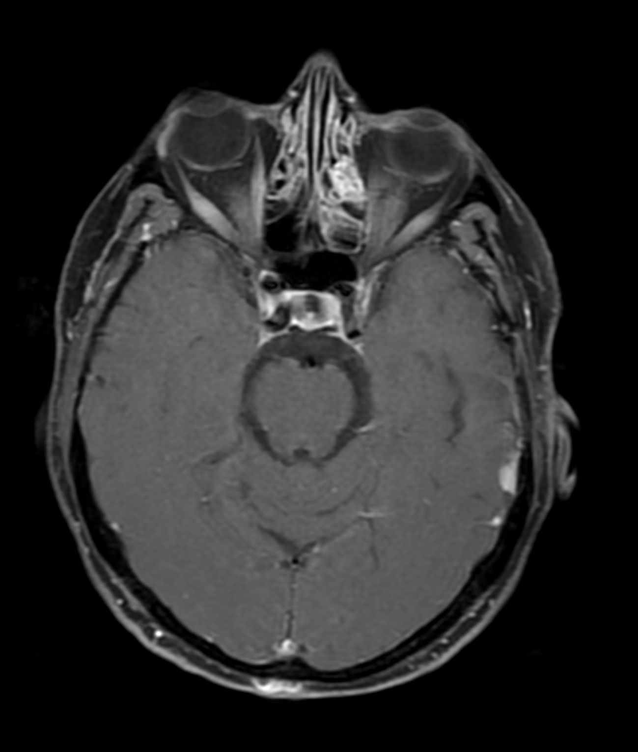 Atypical meningioma | Image | Radiopaedia.org