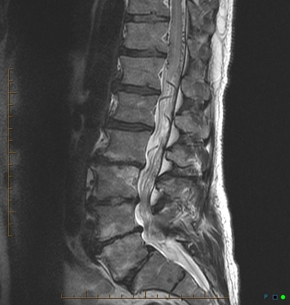 Spinal dural arteriovenous fistula | Radiology Reference Article ...