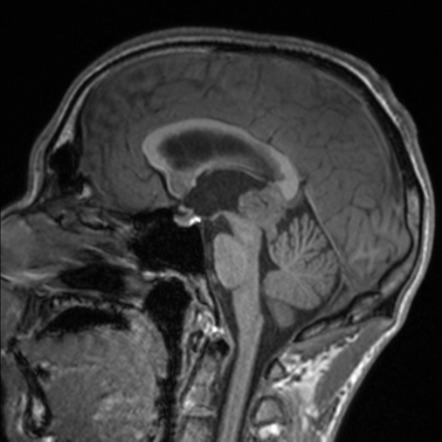 Pineal germinoma | Radiology Case | Radiopaedia.org