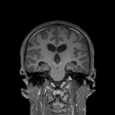 Pineal germinoma | Image | Radiopaedia.org