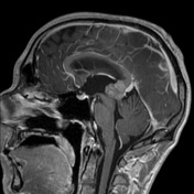 Central nervous system germinoma | Radiology Reference Article ...