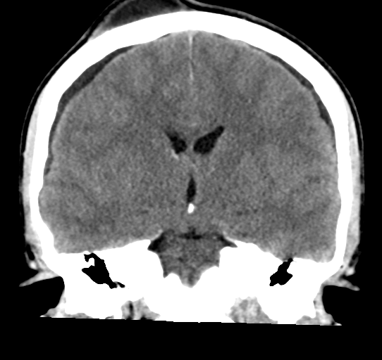 Pineal germinoma | Image | Radiopaedia.org