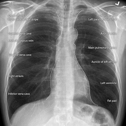 Right ventricular enlargement | Radiology Reference Article ...