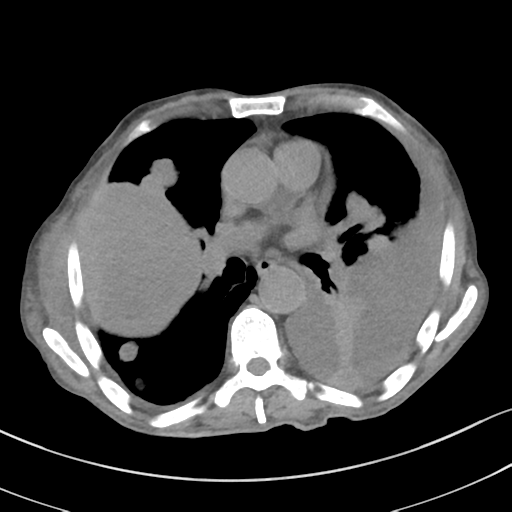 Advanced Metastatic Lung Cancer Image Radiopaedia Org