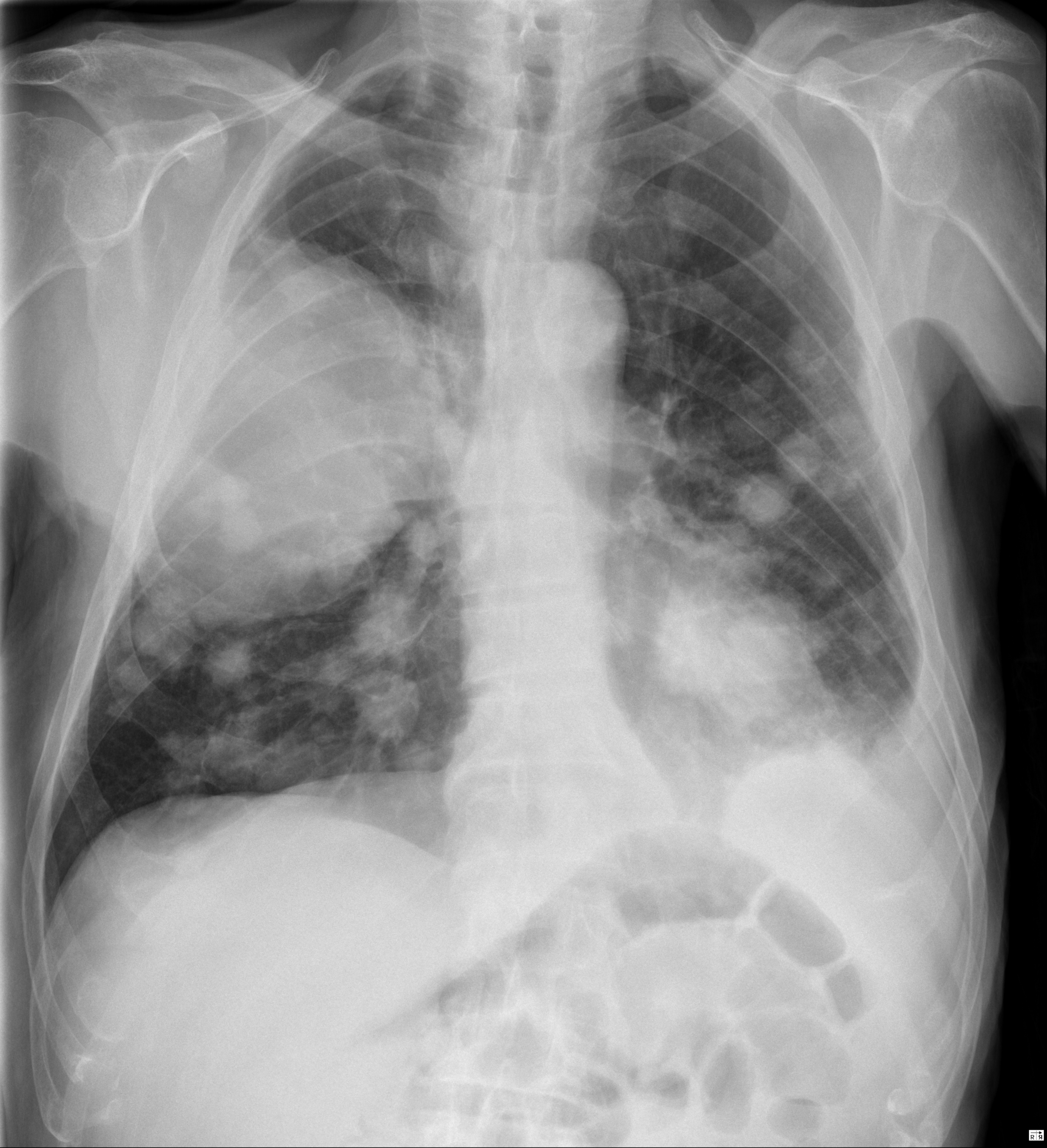 Advanced Metastatic Lung Cancer Image Radiopaedia Org