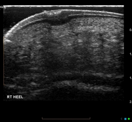 Plantar wart | Radiology Case | Radiopaedia.org