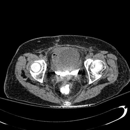 Rectovesical fistula | Image | Radiopaedia.org