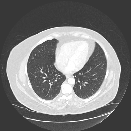 Congenital bronchocele | Image | Radiopaedia.org