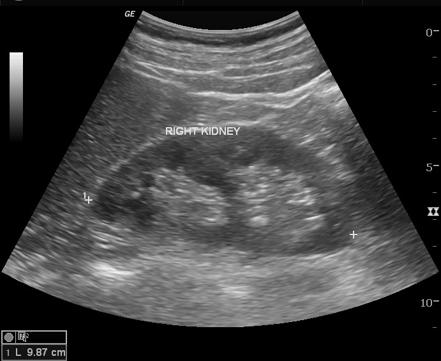 Penile urethral calculus | Image | Radiopaedia.org