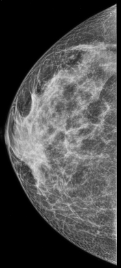 Normal mammography: heterogeneously dense breasts | Image | Radiopaedia.org