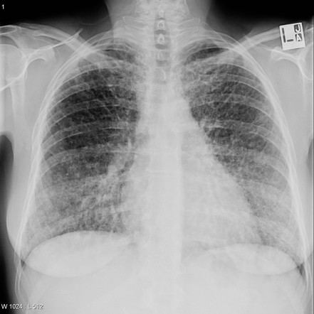 Sarcoidosis | Radiology Case | Radiopaedia.org