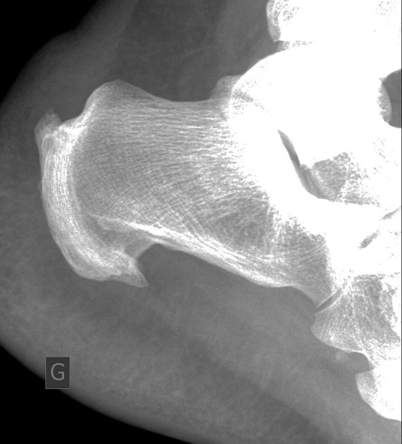 Retrocalcaneal enthesophyte clearance