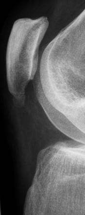 Sinding-Larsen-Johansson disease | Radiology Reference Article