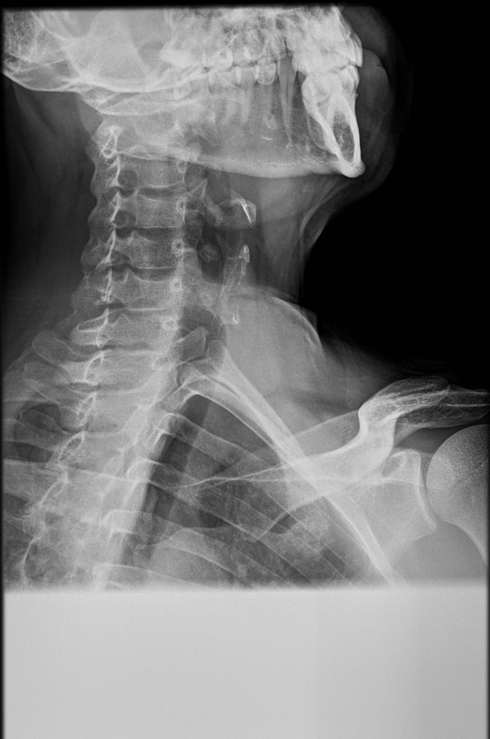 Foreign body (chicken bone) in oropharynx | Image | Radiopaedia.org