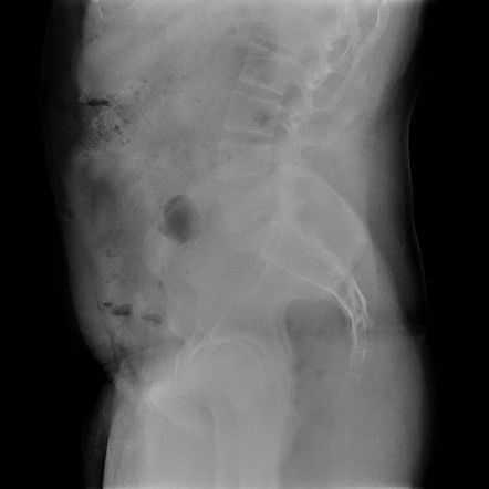 Foreign body (chicken bone) in oropharynx | Image | Radiopaedia.org