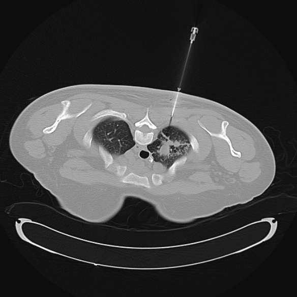 CT guided lung biopsy avoid fissures Image