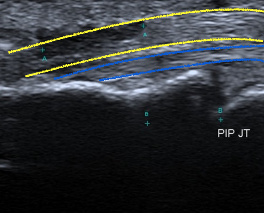 Flexor digitorum profundus tendon partial tear | Image | Radiopaedia.org