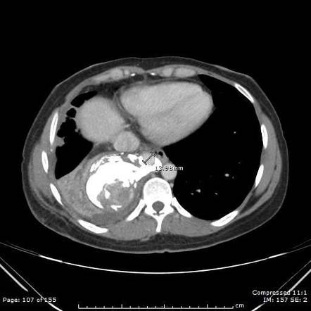 Solitary Fibrous Tumor Of The Pleura | Radiology Reference Article ...