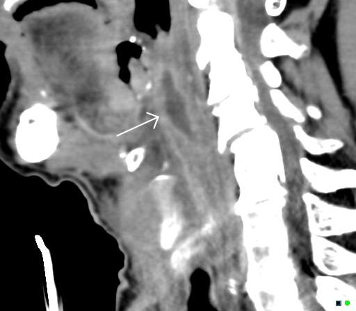 Peritonsillar Abscess Quinsy Image 