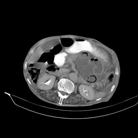 Internal hernia | Radiology Reference Article | Radiopaedia.org