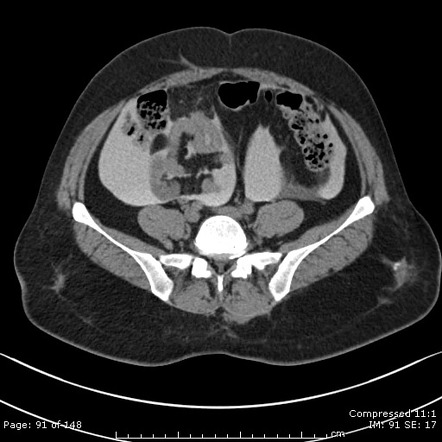 Intraperitoneal bladder rupture | Image | Radiopaedia.org