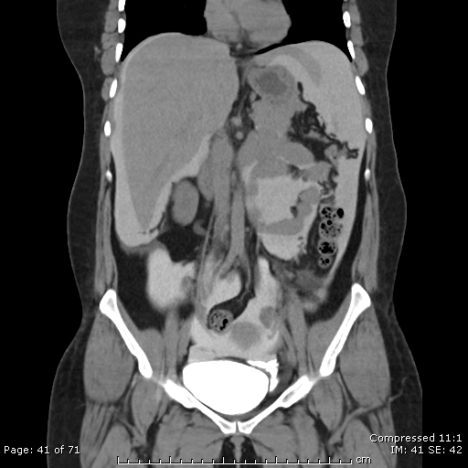 Intraperitoneal bladder rupture | Image | Radiopaedia.org