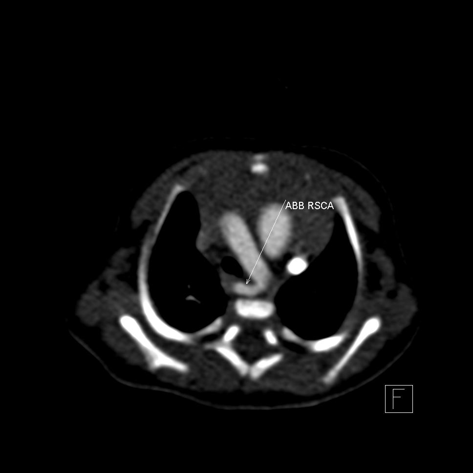 Scimitar syndrome with extra-lobar sequestration | Image | Radiopaedia.org